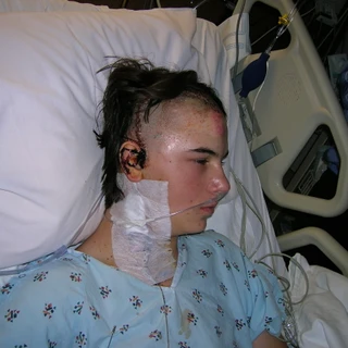 Alex in the hospital after surgery showing staples on head