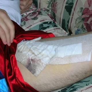 Close up of bandages on Alex's leg